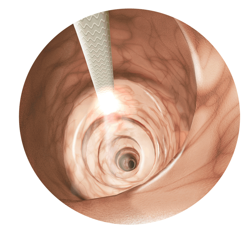 Combined Endoscopy-Laparoscopy Surgery Intestinal