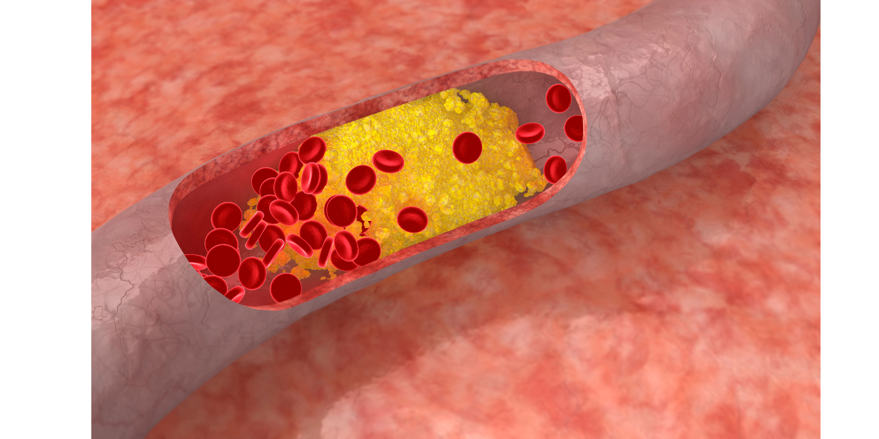 ARMC Honored for Commitment to Lowering Cholesterol Levels in Patient ...